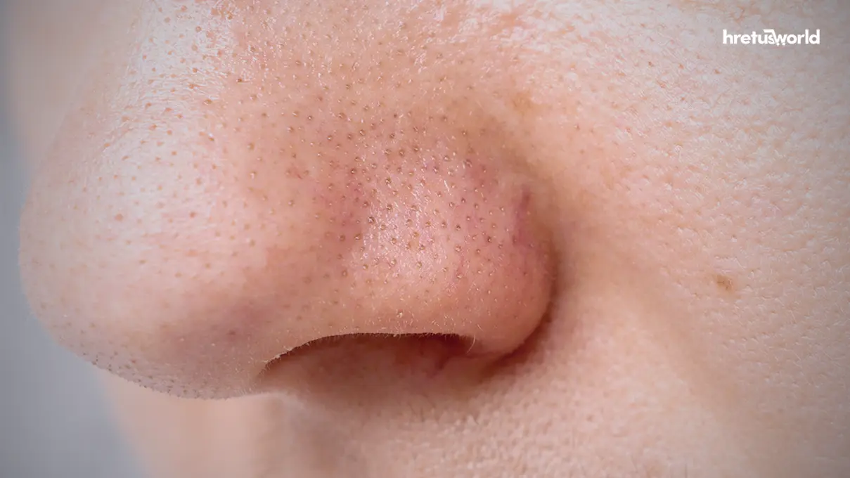 blackheads